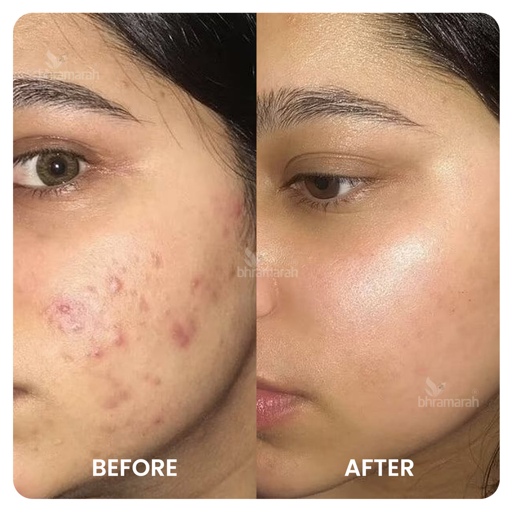 Face Pack Powder For Acne Pimple Control