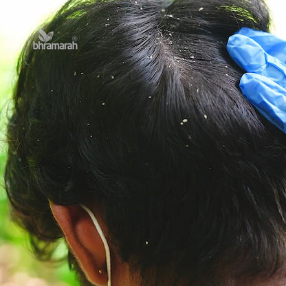 Anti Dandruff Balm